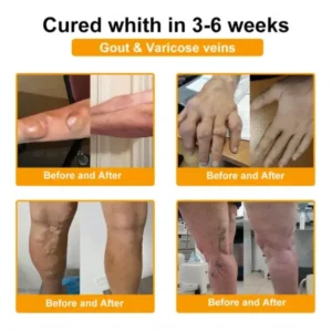 Bee Venom Pain-Relief Bone Healing Spray