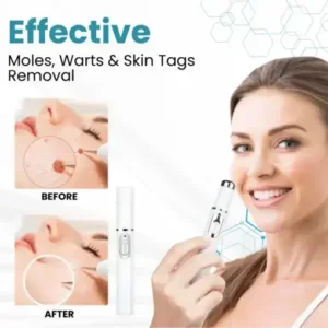 Non-Invasive Mole and Wart Removal Laser Pen