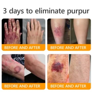 Alternative view of 𝐓𝐚𝐥𝐥𝐨𝐰 𝐁𝐞𝐞 𝐕𝐞𝐧𝐨𝐦 𝐒𝐤𝐢𝐧 𝐑𝐞𝐬𝐭𝐨𝐫𝐚𝐭𝐢𝐨𝐧 𝐂𝐫𝐞𝐚𝐦