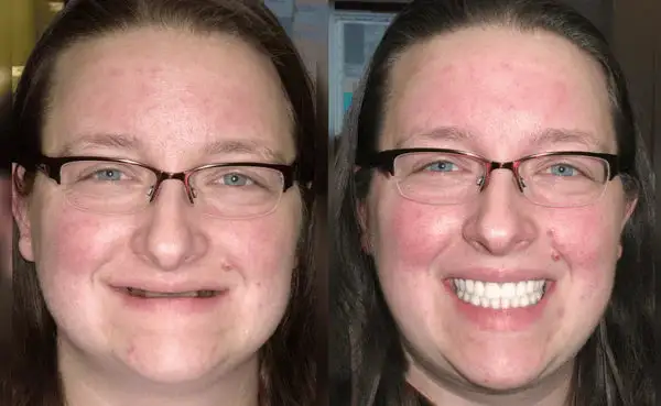 🦷Advanced Customized Full Denture Set🦷 (⏰Limited time discount last 30 minutes⏰) - Image 2