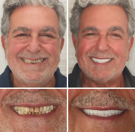 🦷Advanced Customized Full Denture Set🦷 (⏰Limited time discount last 30 minutes⏰) - Image 5