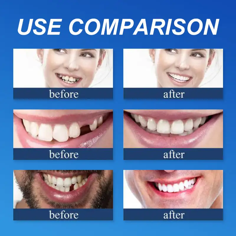 Advanced Customized Full Denture Set - Image 10