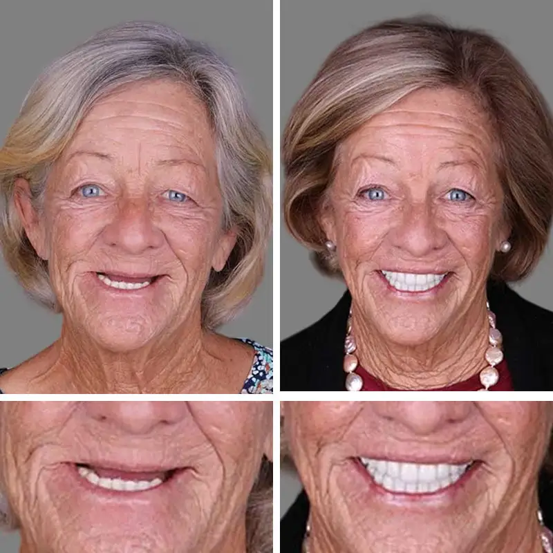 Advanced Customized Full Denture Set - Image 2