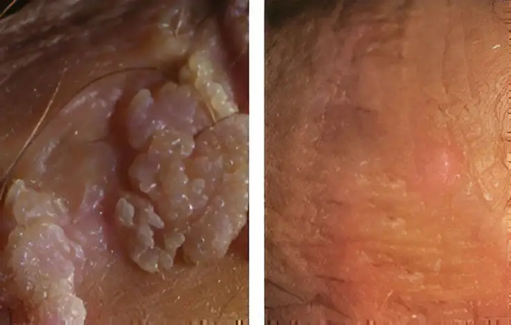 |Genital Warts Remover Cream for Men - Image 21