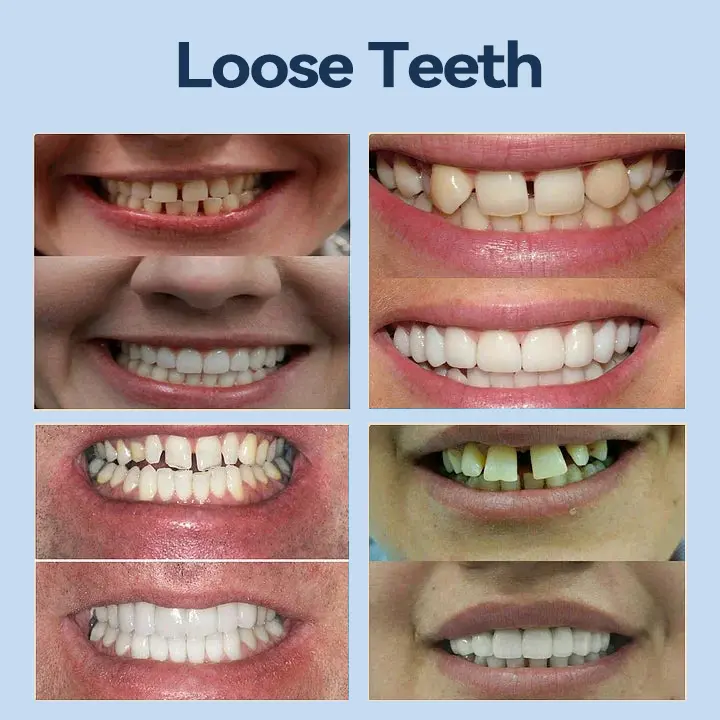 👧🏻🔆- 𝐏𝐫𝐞𝐦𝐢𝐮𝐦 𝐃𝐞𝐧𝐭𝐮𝐫𝐞- (✨Suitable for all mouth shapes, custom-made dentures for a perfect fit✨) - Image 6