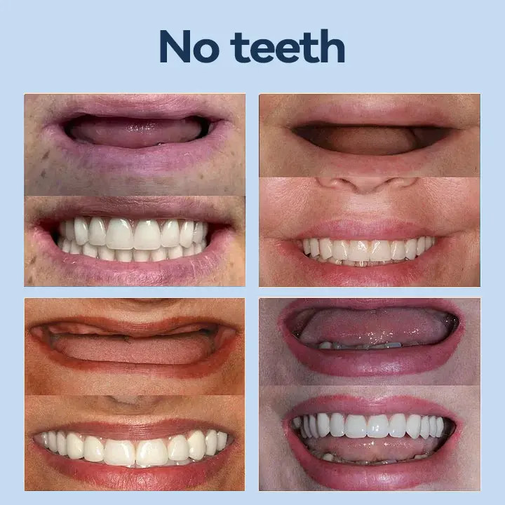 👧🏻🔆- 𝐏𝐫𝐞𝐦𝐢𝐮𝐦 𝐃𝐞𝐧𝐭𝐮𝐫𝐞- (✨Suitable for all mouth shapes, custom-made dentures for a perfect fit✨) - Image 7