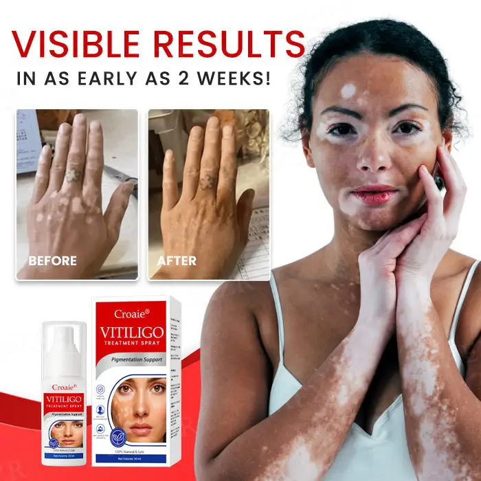 Vitiligo Treatment Spray - Image 6