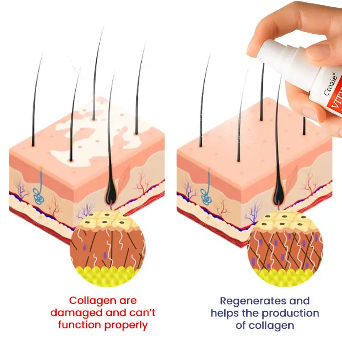 Vitiligo Treatment Spray - Image 7
