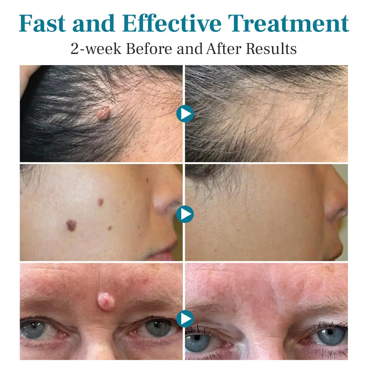 Mole and Wart Removal Laser Pen - Image 8