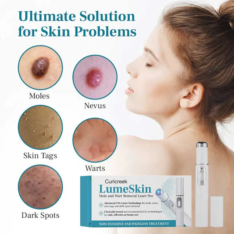 Mole and Wart Removal Laser Pen - Image 3