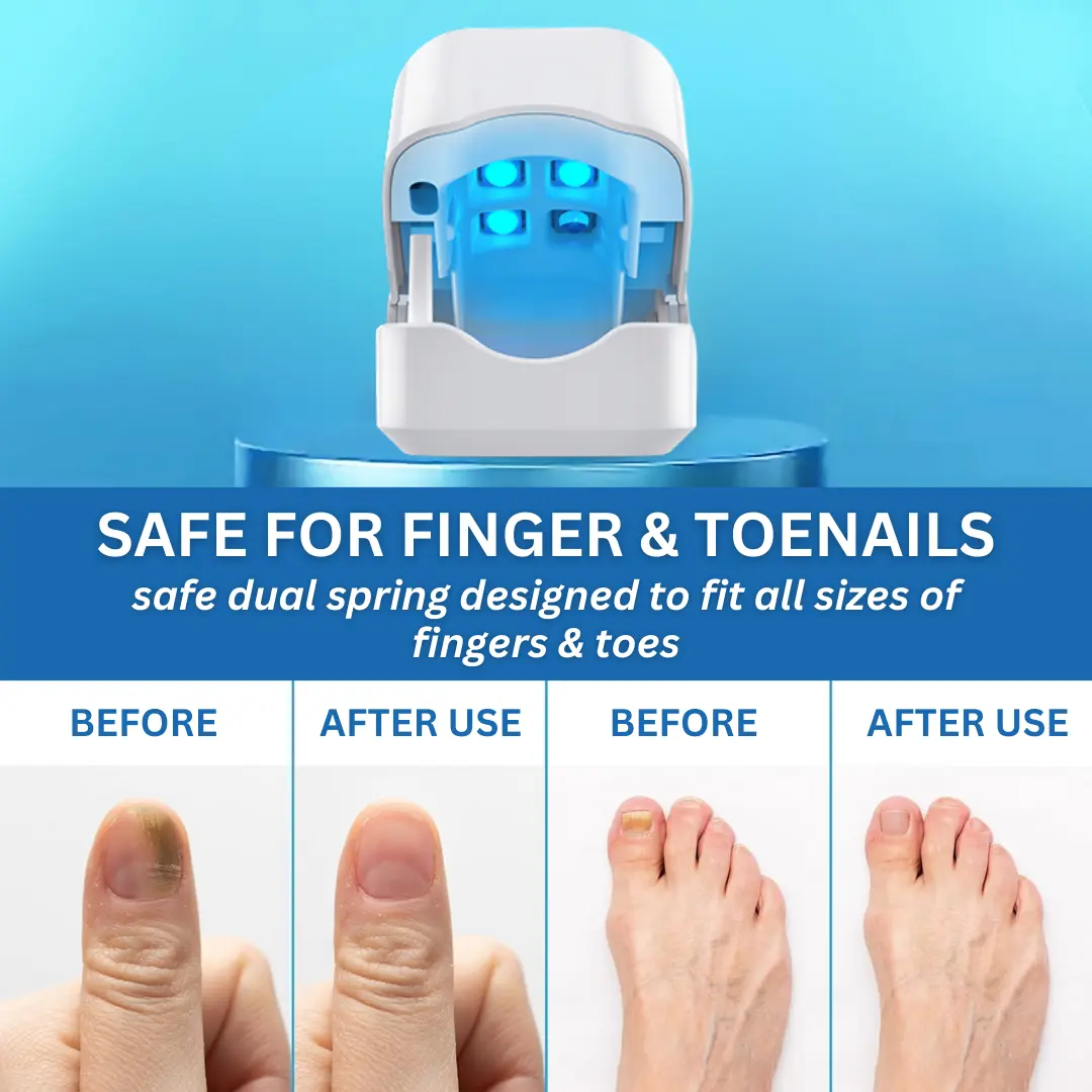 Nail Fungus Laser Treatment Device - Image 5