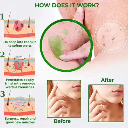 Natural Spot and Mole Removal Cream - Image 5