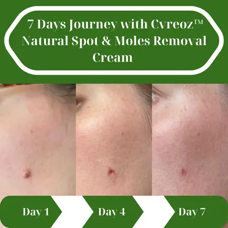 Natural Spot and Mole Removal Cream - Image 8