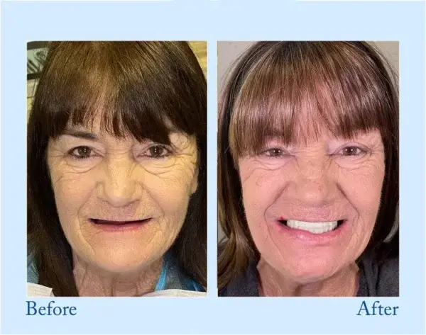 Advanced Dentures - Image 12