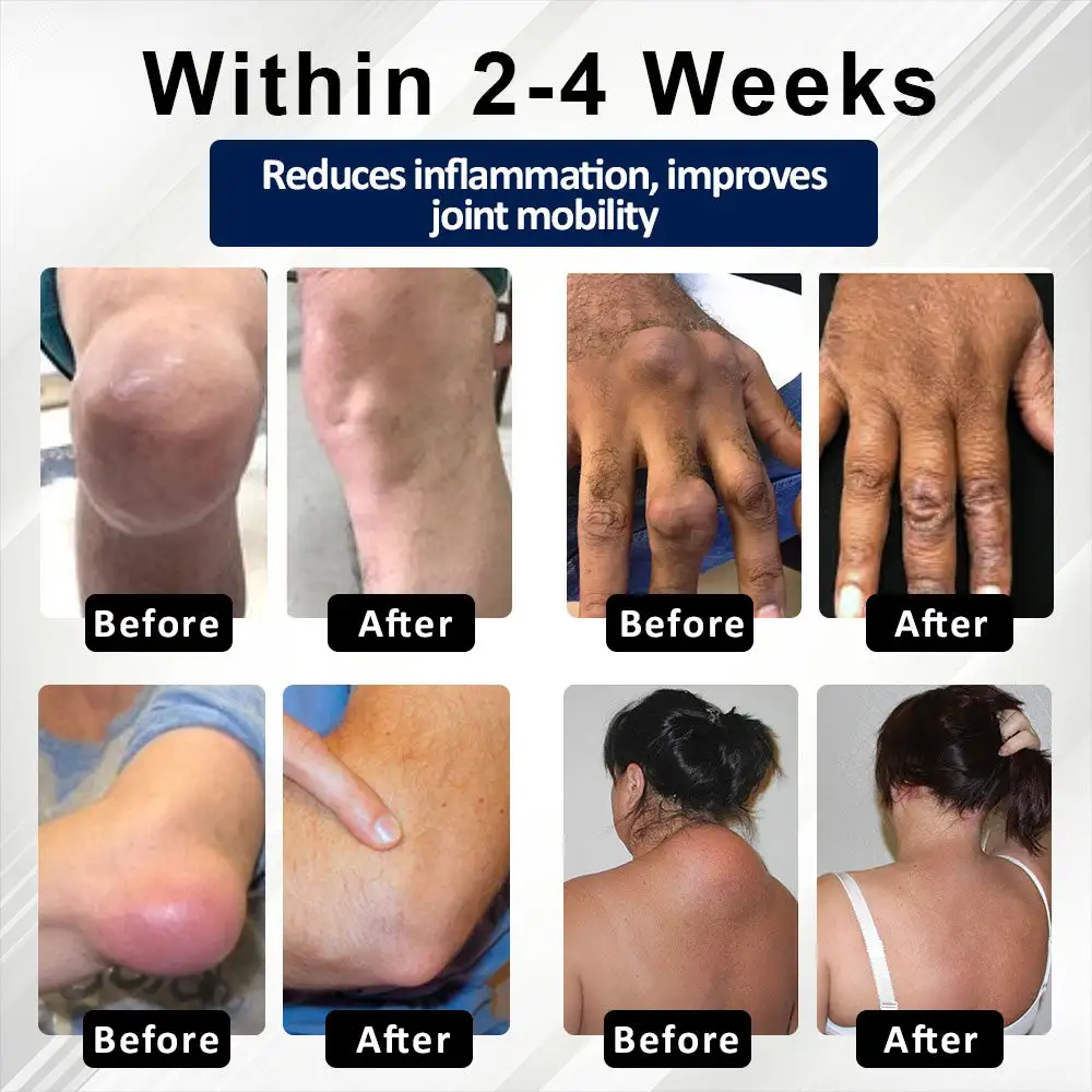 BeeEase MicroSting Joint Patches - Image 2