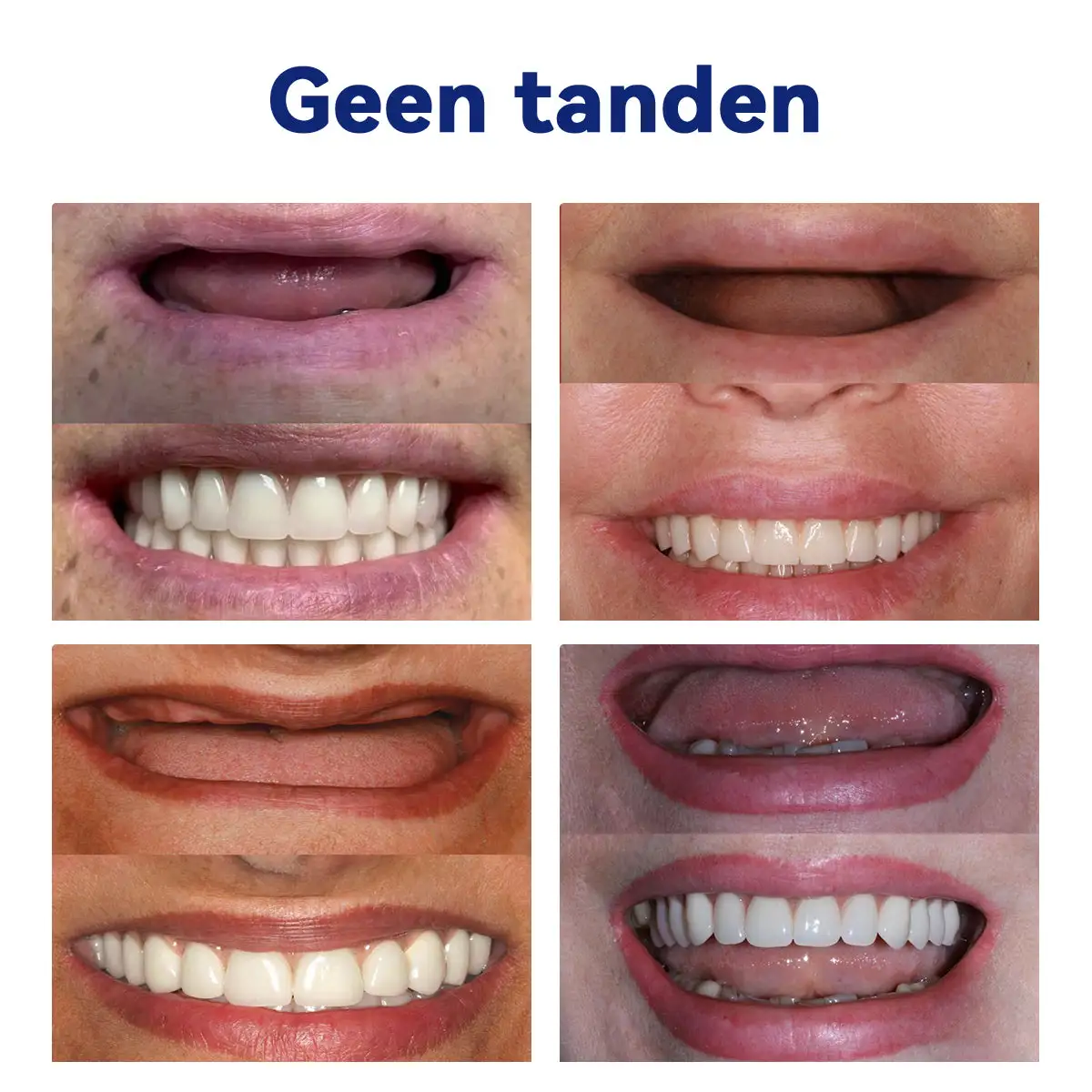 Geavanceerde op maat gemaakte volledige protheseset - Image 13