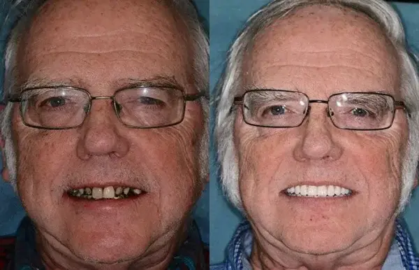 Set di protesi dentarie complete personalizzate avanzate🦷 - Image 11