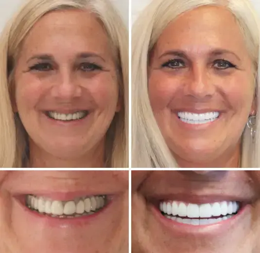 Set di protesi dentarie complete personalizzate avanzate🦷 - Image 8