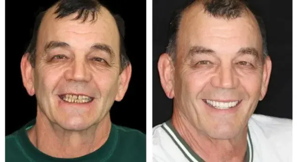 Advanced Customized Full Denture Set - Image 11