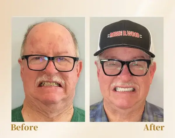 –🦷Advanced Customized Full Denture Set🦷 (⏰Limited time discount last 30 minutes⏰)💎💎 - Image 5