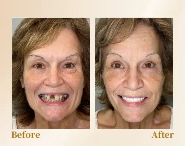 –🦷Advanced Customized Full Denture Set🦷 (⏰Limited time discount last 30 minutes⏰)💎💎 - Image 6