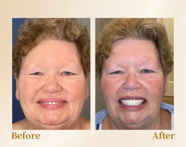 –🦷Advanced Customized Full Denture Set🦷 (⏰Limited time discount last 30 minutes⏰)💎💎 - Image 7