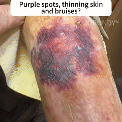 Alternative view of Bee Venom Senile Purpura Cream