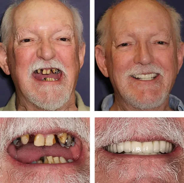 Custom-Fit Functional Dentures — Combination pack - Image 6