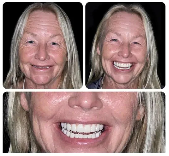 Custom-Fit Functional Dentures — Combination pack - Image 4