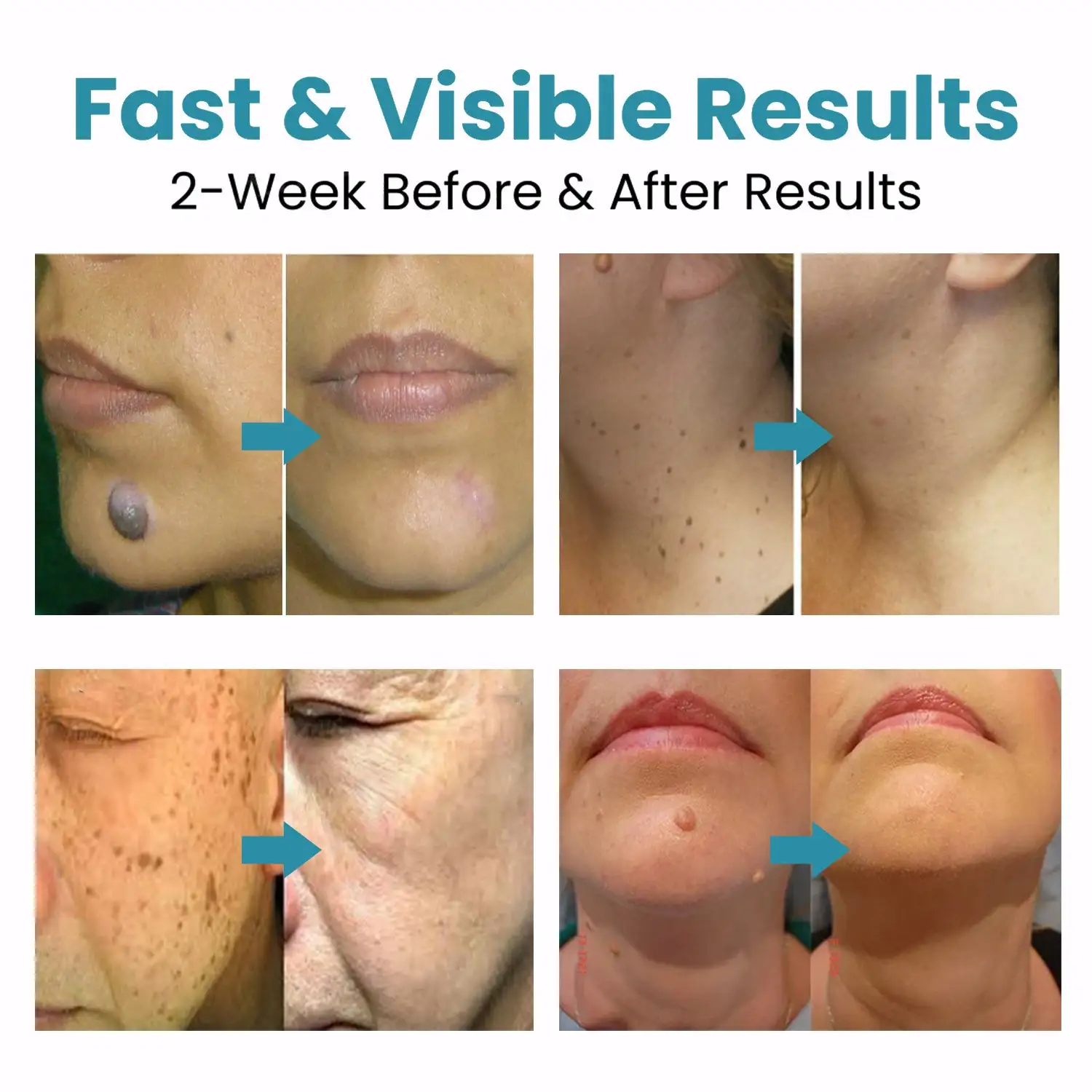 Non-Invasive Mole and Wart Removal Laser Pen - Image 2