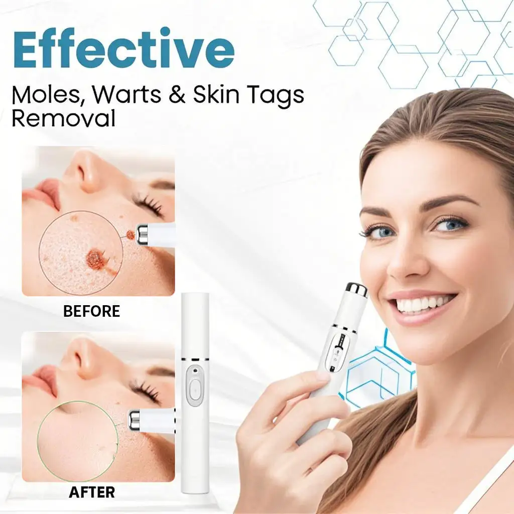 Non-Invasive Mole and Wart Removal Laser Pen - Image 5