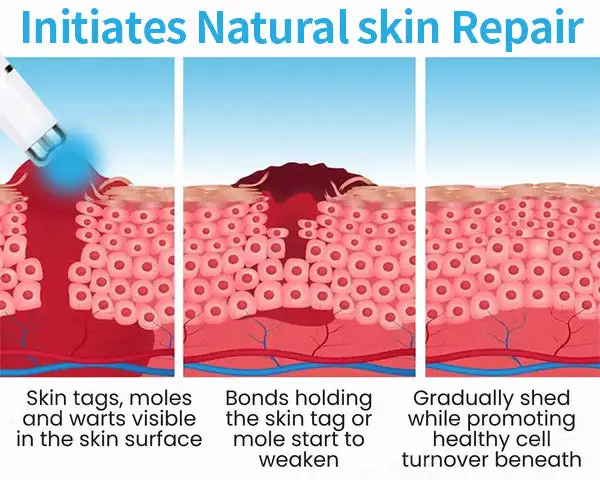 Non-Invasive Mole and Wart Removal Laser Pen - Image 8