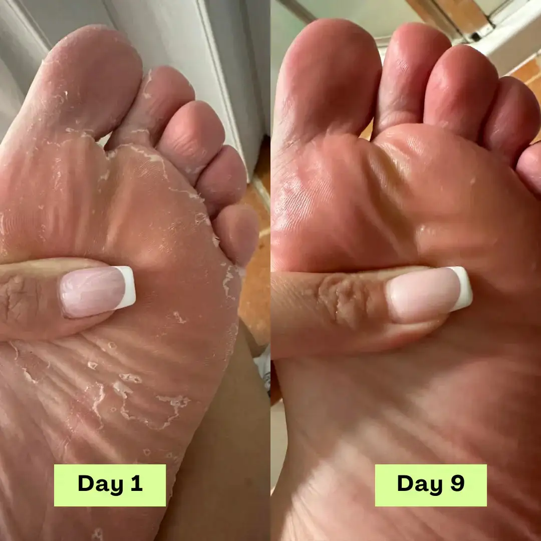 Tea Tree Athlete's Foot Defense Soap - Image 5