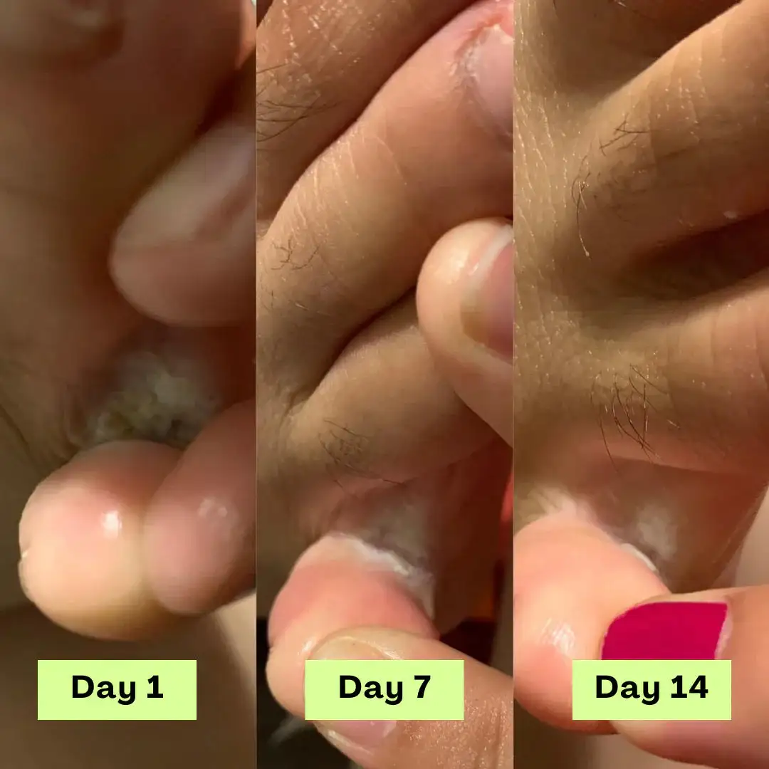 Tea Tree Athlete's Foot Defense Soap - Image 8