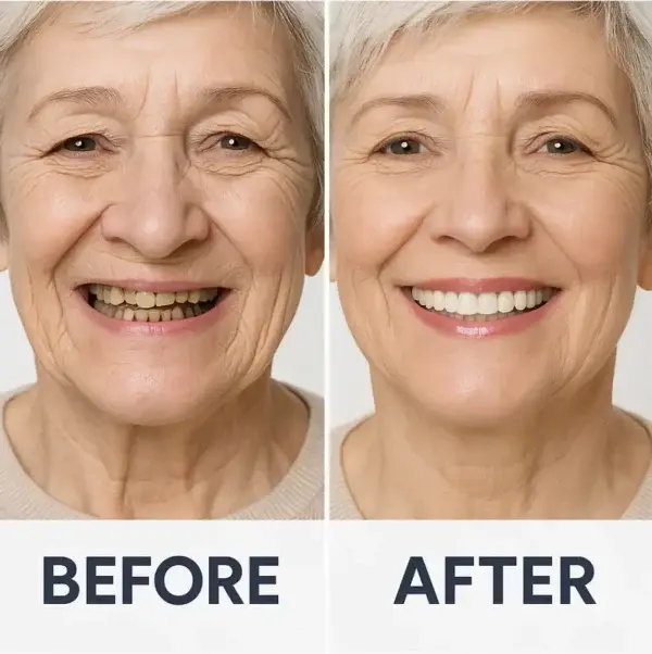 Custom-Fit Functional Dentures - Image 5