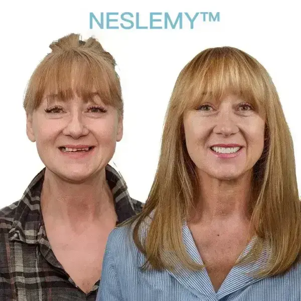 GelFit Dentures - Image 7