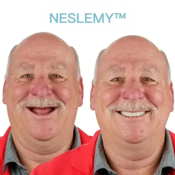 GelFit Dentures - Image 5