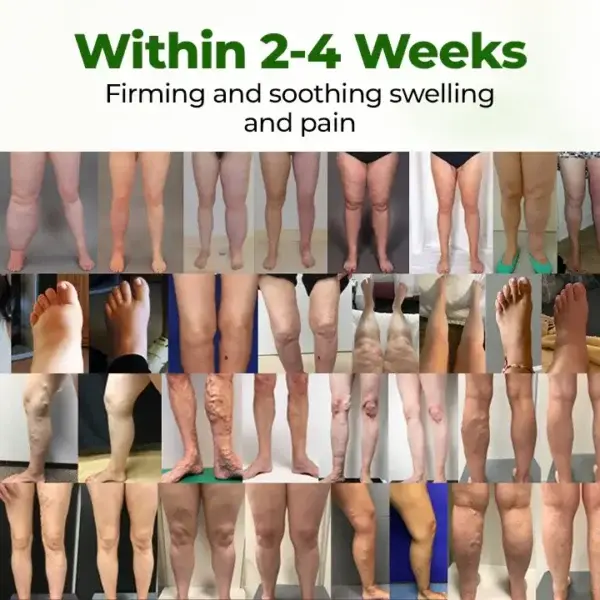 Leg Therapy Edema Cream - Image 5