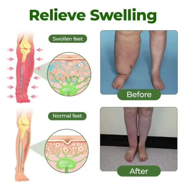 Leg Therapy Edema Cream - Image 7