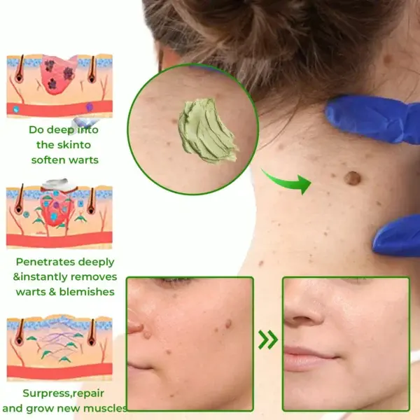 Instant Mole & Spot Cream - Image 11