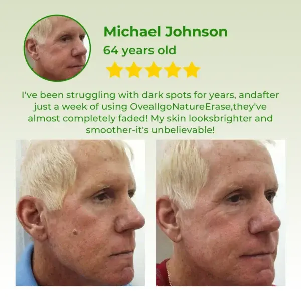 Instant Mole & Spot Cream - Image 3