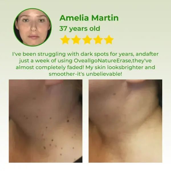 Instant Mole & Spot Cream - Image 4