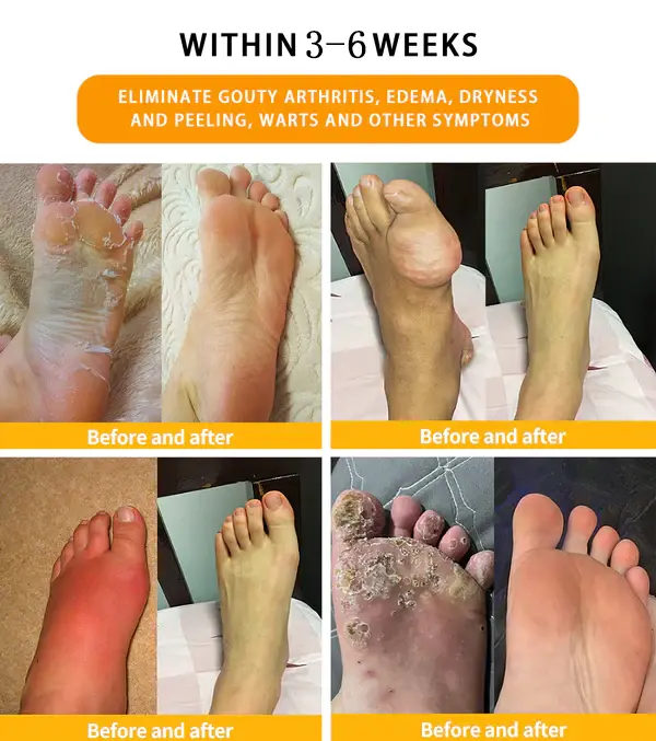 Bee Venom Lymphatic Drainage & Slimming Foot SoakBeads - Image 7