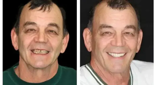 SMILE Premium Denture - Image 11