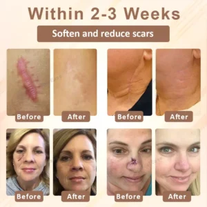 Alternative view of SiliconeFoam Healing Pads