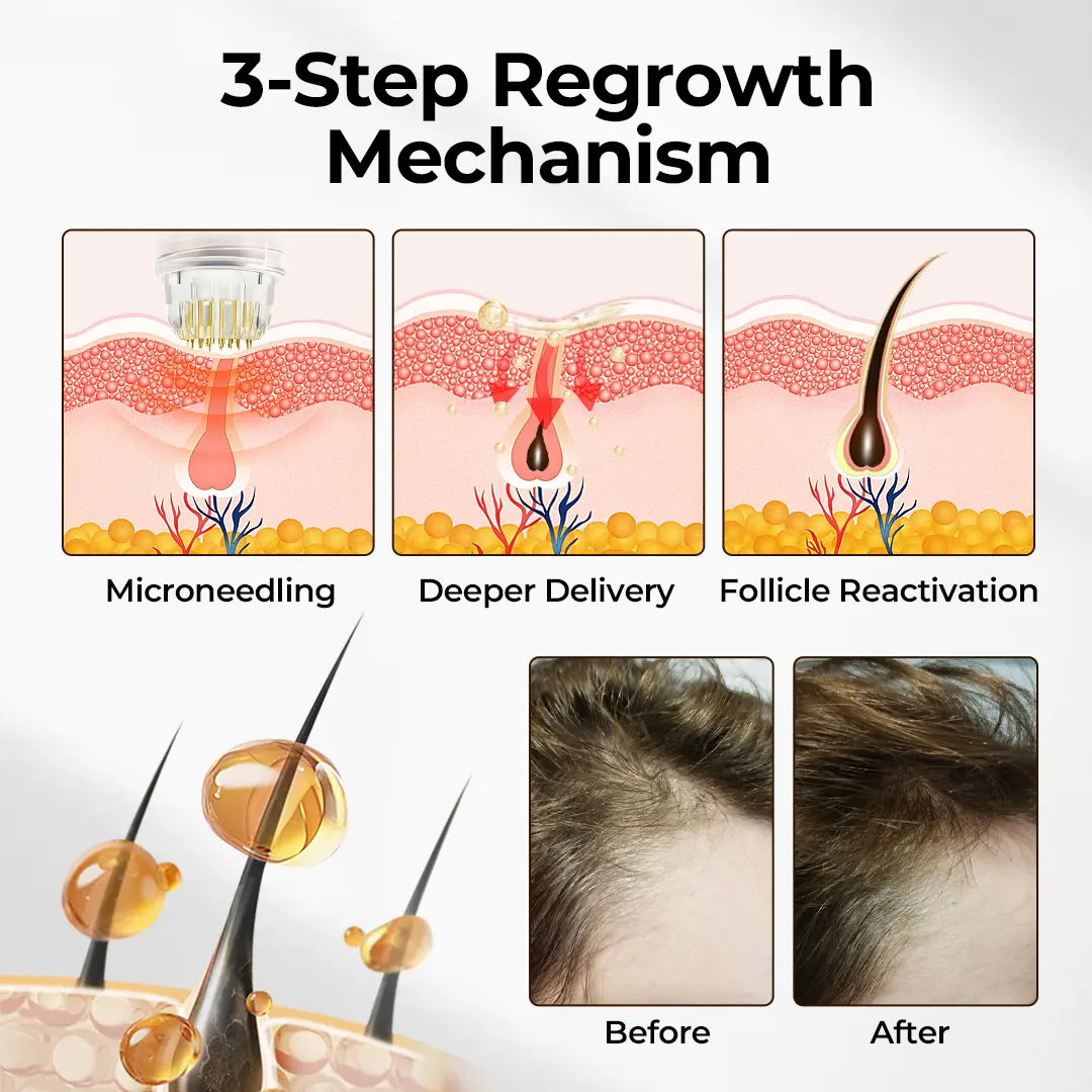 HairFuse Micro-Infusion Hair Regrowth Kit - Image 2