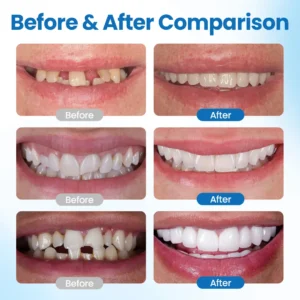 Alternative view of SmileMend Tooth Repair Filling Kit
