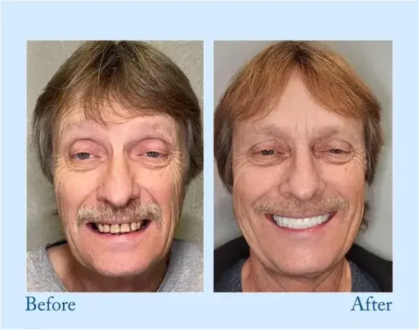 TrueEase Dentures - Image 9