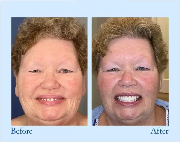 Full Dentures - Image 11