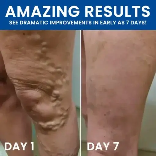 Varicose Treatment Pill Patch - Image 5